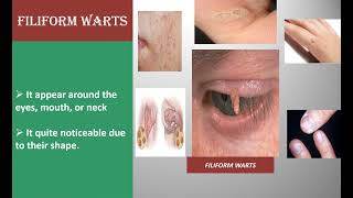 MEDICAL TREATMENTS OF DIFFERENT TYPE WARTS [upl. by Richardson761]