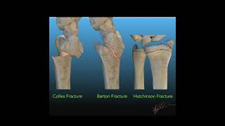 Barton Fracture Symptoms and Causes  Diagnosis  Treatment  Prevention health [upl. by Elvira288]