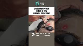 Laser Therapy for Nevus of OTA Removal Treatment  Nevus of OTA Treatment in Delhi  Dr PK Talwar [upl. by Janel]