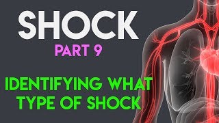 Identifying What Type Shock  Shock Part 9 [upl. by Salvucci132]