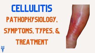 CELLULITIS Pathophysiology Types Treatment Symptoms amp Nursing Interventions [upl. by Mashe278]