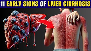 LIVER is DYING 11 Early Warning Signs of Liver Cirrhosis You Cant Ignore  Healthy Care [upl. by Zitella]