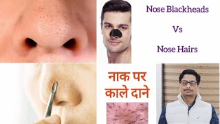 Trichostasis Spinulosa  Nose Blackheads  Nose Hairs  Nose Acne नाक पर काले दाने और बाल nosehair [upl. by Su]