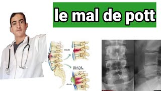 le mal de pott ou spondylodiscite tuberculeuse [upl. by Leontyne]