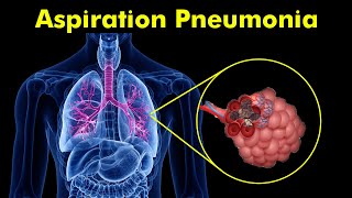 Breathing Trouble Understanding Aspiration Pneumonia [upl. by Wivina]