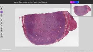 Medullary Thyroid Carcinoma [upl. by Eleira]