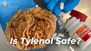 Should You Stop Taking Tylenol AcetaminophenParacetamol [upl. by Leumek]