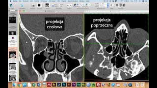 RTG i TK  przykłady badań z różnicami i możliwościami obu metod [upl. by Moreville]