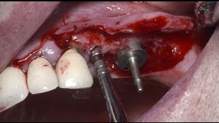 Sinus lifting using Osteotome [upl. by Bierman]