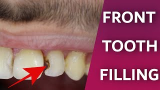 Front Teeth Filling Process  Dentist do front tooth decay repair  Composite bonding restoration [upl. by Haerle]