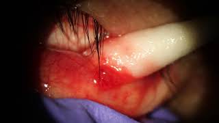 Chalazion Popped on inner eyelid w needle [upl. by Chic174]