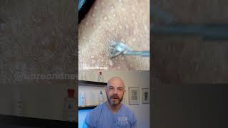 Derm reacts to inflamed ingrown hair removal ingrownhair [upl. by Madora]