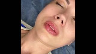 Rose Lips application with microneedling [upl. by Yila]