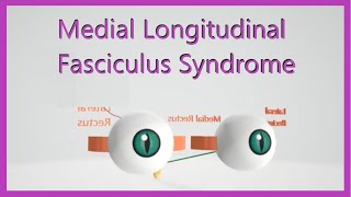 Medial Longitudinal Fasciculus Syndrome [upl. by Yeslaehc]