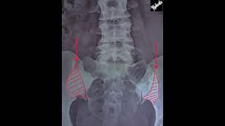 Osteitis Condensans Ilii vs Sacroiliitis [upl. by Wynn64]