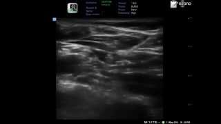 ultrasound guided supraclavicular brachial plexus block in one minute only [upl. by Nolahs]