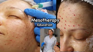 Mesotherapy for Face including around the Eyes injection technique using 13mm 30G needle [upl. by Marguerite141]