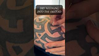 DRY NEEDLING INTO THE DELTOID [upl. by Byron560]