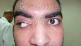 Constant Exotropia  الحول الوحشي الدائم [upl. by Nauwaj]