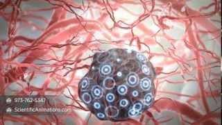 Interventional Radiology Treatment for Liver Cancer [upl. by Connor917]