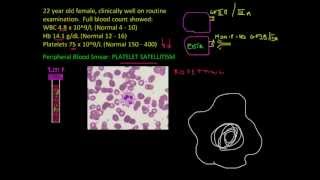 Platelet satellitism  Full Blood Count Masterclass series [upl. by Ainimre]