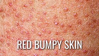 Keratosis Pilaris  How To Get Rid of Chicken Skin [upl. by Fallon]