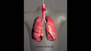 Lung SoundsNormal and AbnormalCracklesWheeze StridorRonchiOn Respiratory Auscultation Sound [upl. by Burn539]