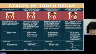 Tooth decay Definition Epidemiology of caries prevalence and intensity of caries [upl. by Leinad]