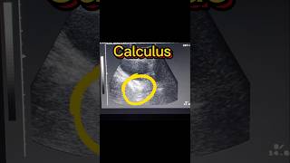 Bladder Stone  Vesical Stone  Vesicle Calculus  Cystitis  UTI ultrasound [upl. by Llerahs]