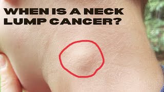 Could My Neck Lump Be Cancer Such as Lymphoma [upl. by Acisseg]