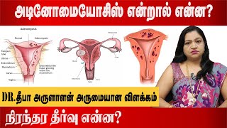 அடினோமையோசிஸ் என்றால் என்ன  adenomyosis treatment without surgery  Dr Deepa Arulaalan [upl. by Nrubua232]