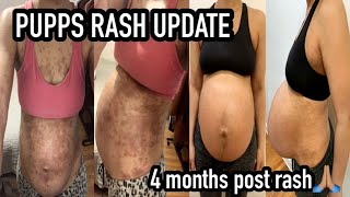 UPDATE PREGNANCY RASH  PUPPS RASH [upl. by Saitam825]