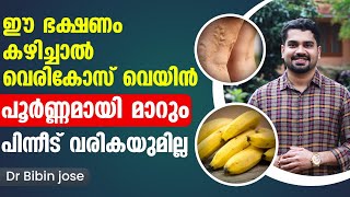 ഈ ഭക്ഷണങ്ങൾ കഴിച്ചു വെരികോസ് വെയ്ൻ പൂർണമായി മാറ്റം Vericose Treatment in Malayalam Dr Bibin Jose [upl. by Addy564]