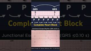 Third Degree Atrioventricular Block ECG Junctional Escape Rhythm [upl. by Nerval]