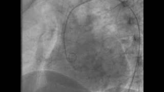 Aortogram with Aortic Insufficiency [upl. by Haleeuqa]