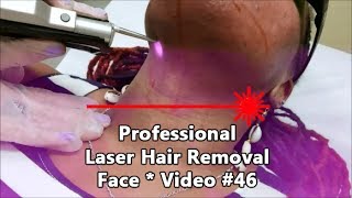 Professional Laser Hair Removal  Face  Video 🎥 46 [upl. by Merriott761]