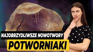 Najobrzydliwsze nowotwory  potworniaki [upl. by Eerot]