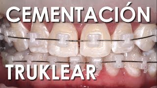 CEMENTACIÓN BRACKETS DE AUTOLIGADO CERÁMICOS  Ventajas y Desventajas [upl. by Belanger705]