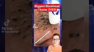 BIGGEST BLACKHEADS REMOVAL EVER  Extreme Blackheads on Cheek shorts [upl. by Corie]