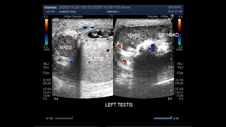 Ultrasound Video showing Epididymoorchitis Pyocele with septation Scrotal and Epididymal mass [upl. by Entwistle]