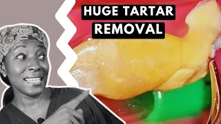 Massive TARTAR REMOVAL from teeth  TEETH CLEANING [upl. by Leehar]