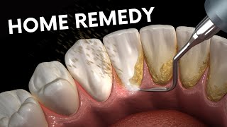 Teeth plaque tartar removal  Health Go [upl. by Eerok697]