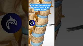 How is surgery in completely herniated disc 3d animation anatomy ytshorts spinalcord [upl. by Jarret]