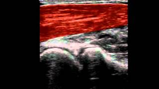 Musculoskeletal Ultrasound Elbow 1 anterior humeroradial longitudinal scan [upl. by Pachton623]