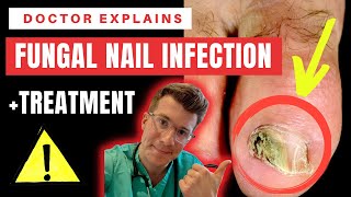 How to recognise diagnose amp treat FUNGAL NAIL INFECTION Onychomycosis  Doctor ODonovan explains [upl. by Werra659]