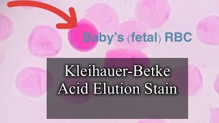 KleihauerBetke Stain to detect FetalMaternal Hemorrhage [upl. by Ellecram]