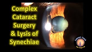 Complex Cataract Surgery multiple challenging issues [upl. by Ynittirb]