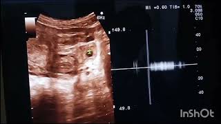 ectopic pregnancy ultrasound [upl. by Kovacev]