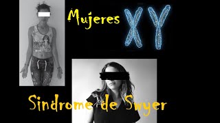 Mujeres XY Síndrome de Swyer o Disgenesia gonadal completa XY [upl. by Nelram]