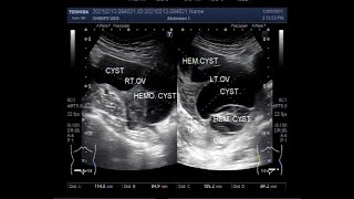 Bilateral Multiple Ovarian Cysts and Ovarian Mass [upl. by Jaye869]